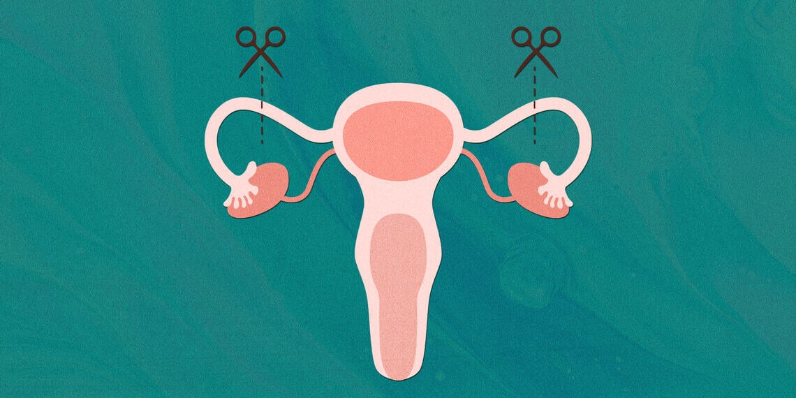 Illustration of tubal ligation